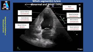 Wall Motion Abnormality Part II cases amp practice [upl. by Ttevi]