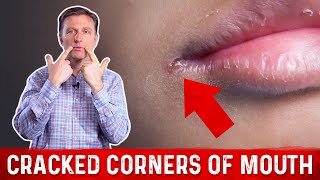 What Causes Cracked Corners of Mouth amp How to Get Rid of Angular Cheilitis – Dr Berg [upl. by Ettedualc]