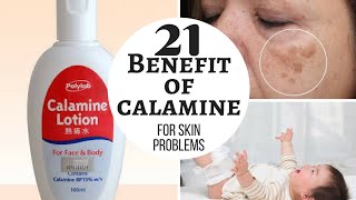 CALAMINE lotion  Lacto calamine lotion uses in detail side effects [upl. by Anenahs]