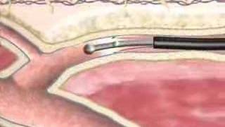 Vein Closure the Difference Between EVLT amp RFA Procedures [upl. by Eiddam946]