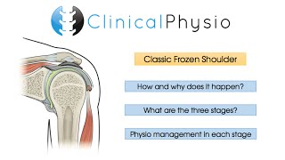 Classic Frozen Shoulder  Clinical Physio [upl. by Prakash887]