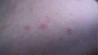 Shingles Rash Early Stages [upl. by Wystand]