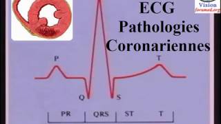 Interprétation de LÉlectrocardiogramme ischémie et infarctus du myocarde [upl. by Arihas487]