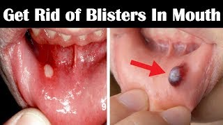 How to Get Rid of Blisters in Mouth Fast  Home Remedies for Blisters in Mouth and Tongue [upl. by Braynard922]