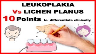 leukoplakia vs lichen planus  10 points to differentiate clinically [upl. by Thoma606]