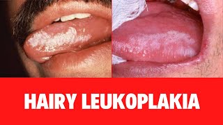 WHAT IS HAIRY LEUKOPLAKIA Oral Hairy Leukoplakia Symptoms Causes Diagnosis Treatment [upl. by Rapsag]