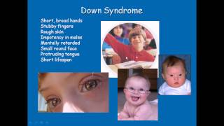 Chromosomal disorders [upl. by Hans]