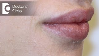 Causes of white spots on lipsDr Nischal K [upl. by Otrebile]