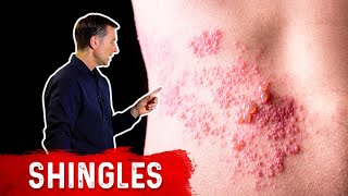 Shingles Natural Relief [upl. by Ardehs]