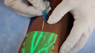 New medical technology helps nurses insert an IV on the first try [upl. by Lalita465]