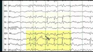 Focal EEG Abnormalities 1 [upl. by Negriv827]