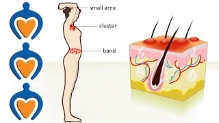 The Stages Signs amp Symptoms of Shingles [upl. by Bayless]