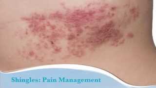 What is Shingles [upl. by Notxam]