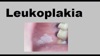 Leukoplakia [upl. by Loise225]